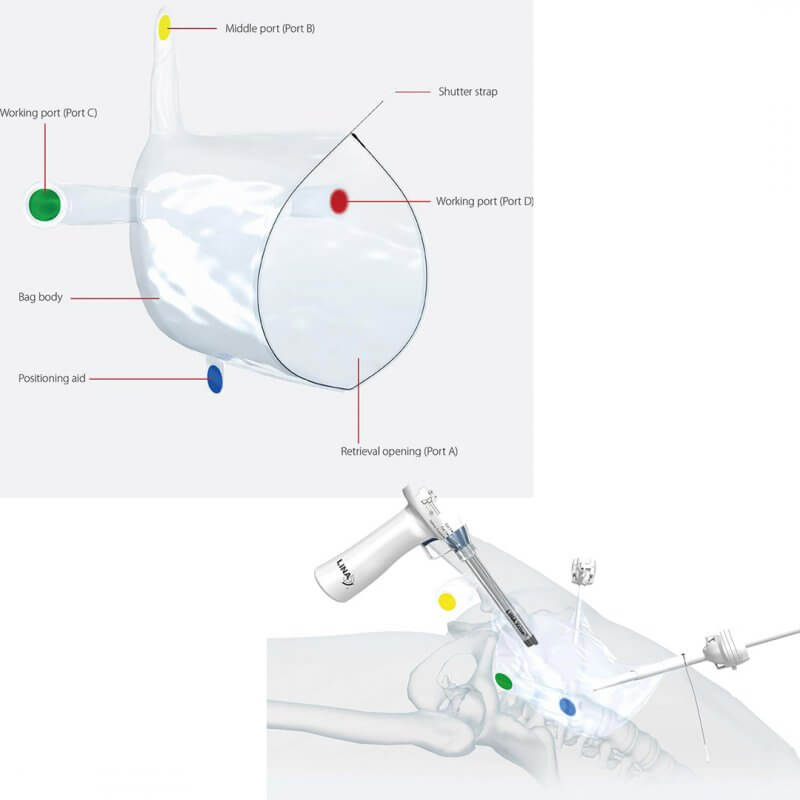 Frontiers | Application of Single-Port Laparoscopic Surgery in Myomectomy